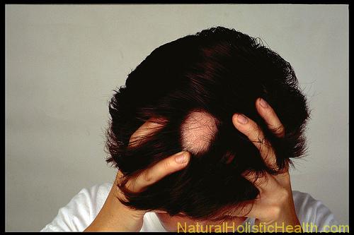 3331909832 247605ec2c alopecia