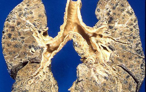 4563271516 ddd66c6259 emphysema e1486527409131