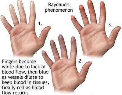 Raynauds e1486600106597