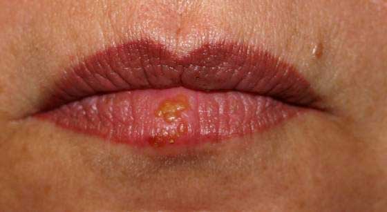 cold sore31