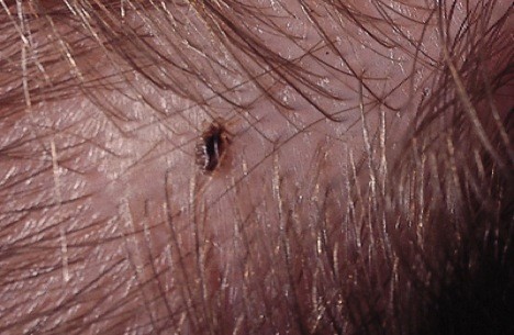 head lice treatment